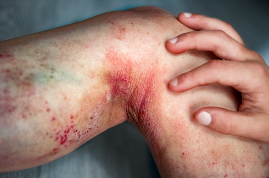 How to cure eczema permanently with home remedies - an image of a child with severe eczema