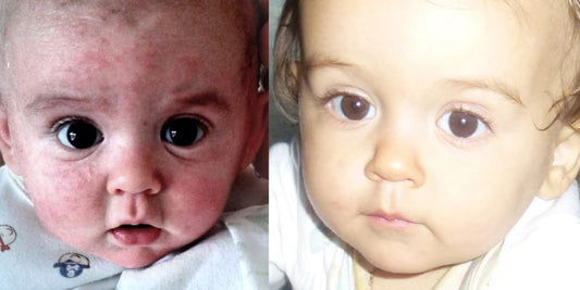 How I Made a Natural Product for My Baby’s Eczema